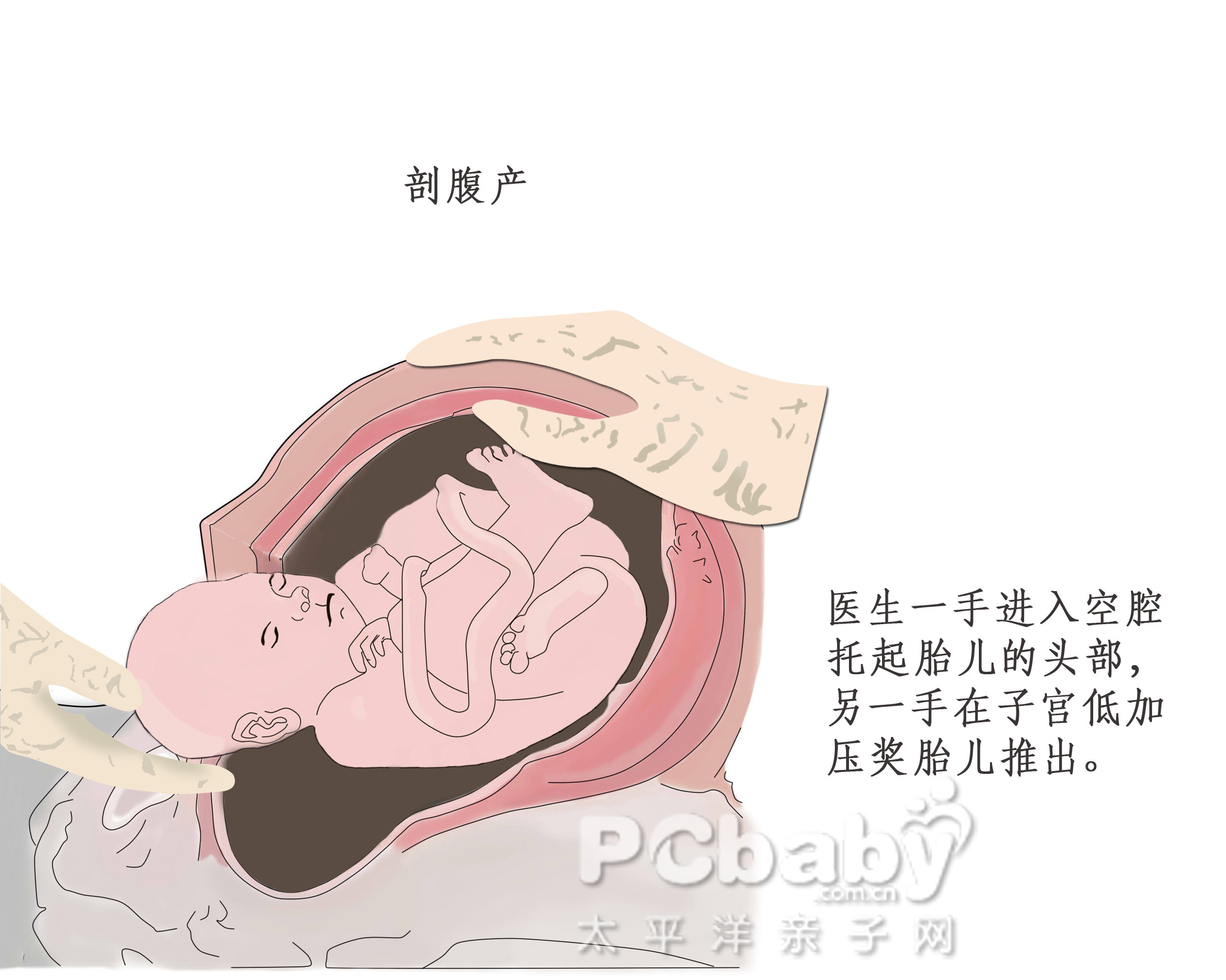 剖宫产就是剖腹产？错啦，有一种剖宫产术式就无需打开腹腔！_腹膜